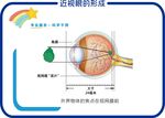 近視眼的形成