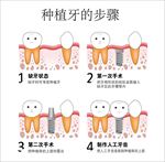 种植牙的步骤