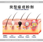 医学皮肤痤疮粉刺解剖图