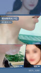 玻尿酸填充下巴