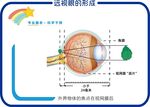 远视眼的形成