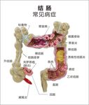 结肠常见病症解剖示意图