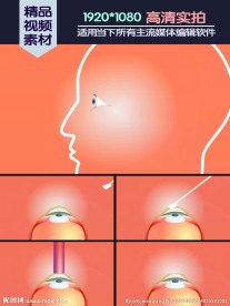 激光光学角膜切削术医学演示动画