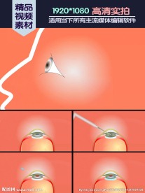 白内障手术医学演示动画