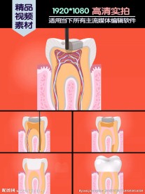 牙髓填充医学演示动画