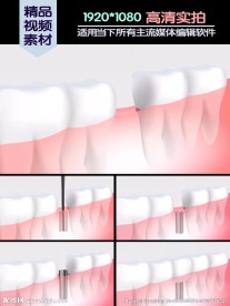 种植牙医学演示动画