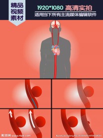 动脉瘤导流医学演示动画