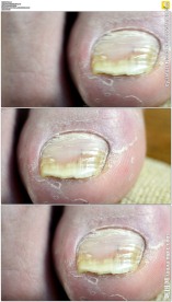 指甲真菌感染病变