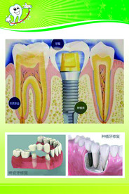 种植牙、烤瓷牙修复结构图