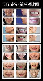 牙齿矫正