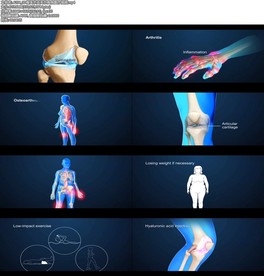 A204_3D骨关节炎关节疾病