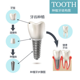 牙齿治疗 种植牙结构图矢量图