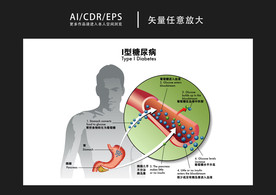 矢量医学I型糖尿病图解插画