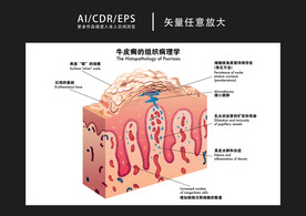 矢量医学牛皮癣图解插画