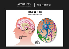 矢量医学帕金森氏病图解插画