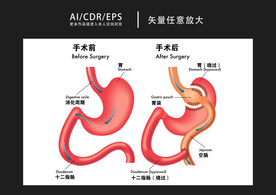 矢量医学肺部手术图解插画