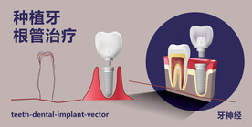 牙齿治疗 种植牙结构图