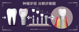 种植牙冠 分解步骤图