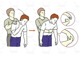 海姆立克急救法示意图