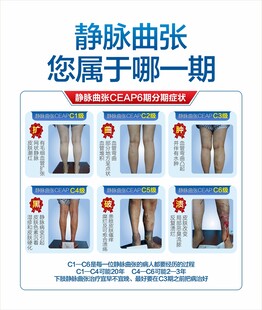 静脉曲张分期图