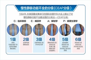静脉曲张分期图